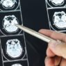 brain injury