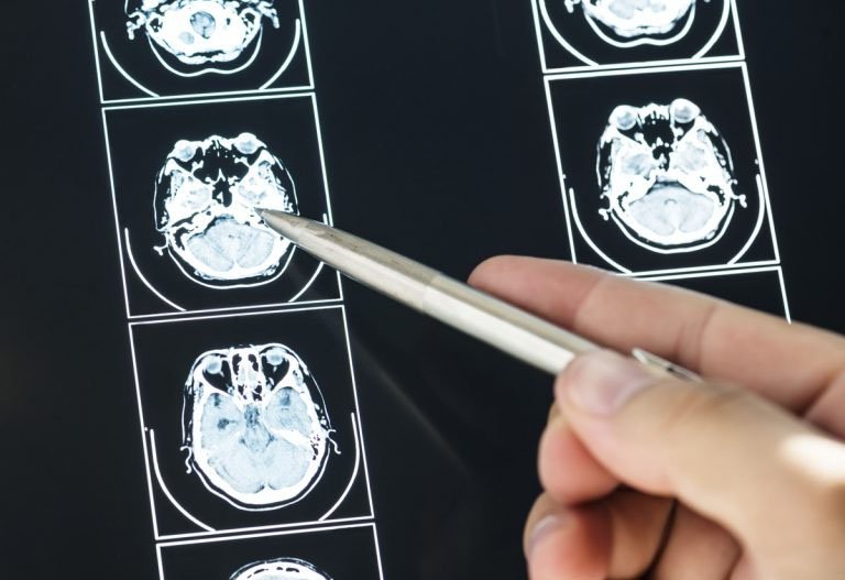 brain injury