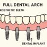 a patients guide to all on x dental implants
