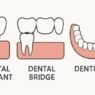 comparing dental implants and other tooth replacement options
