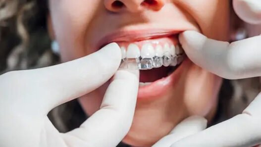 5 common questions patients ask about clear aligners