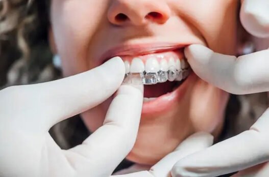 5 common questions patients ask about clear aligners