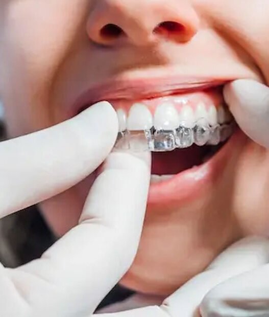 5 common questions patients ask about clear aligners
