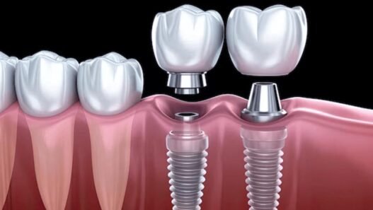how implant dentistry can transform both your smile and your bite