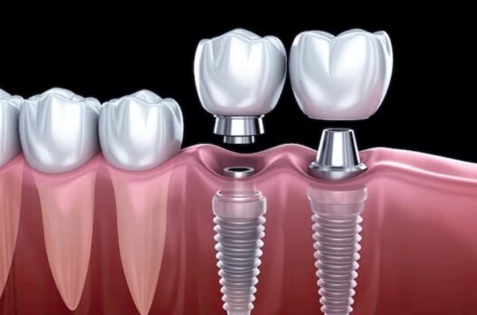 how implant dentistry can transform both your smile and your bite