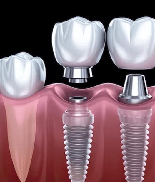 how implant dentistry can transform both your smile and your bite