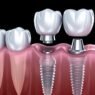 how implant dentistry can transform both your smile and your bite