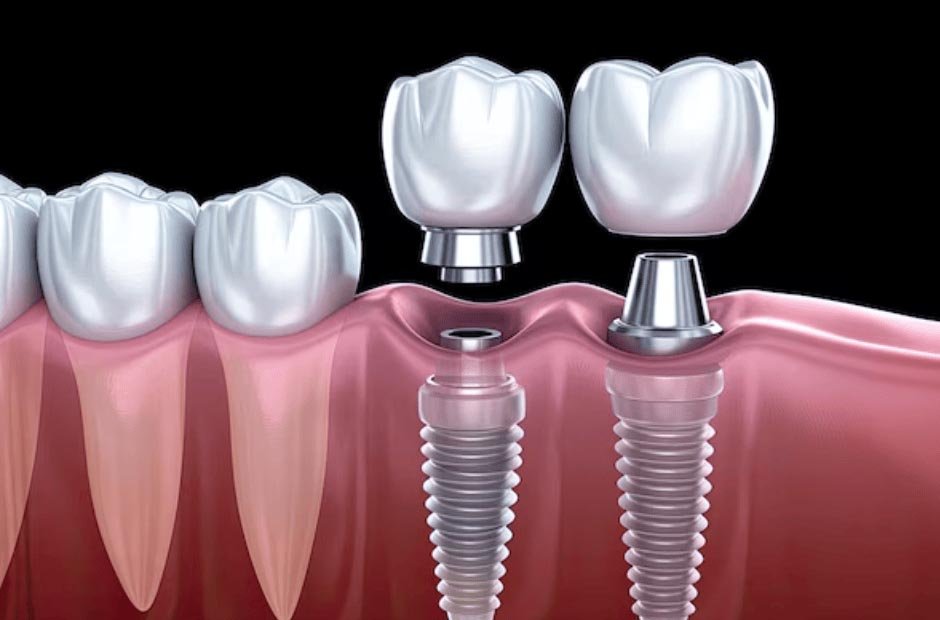 how implant dentistry can transform both your smile and your bite