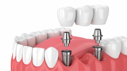 why immediate implants are growing in popularity