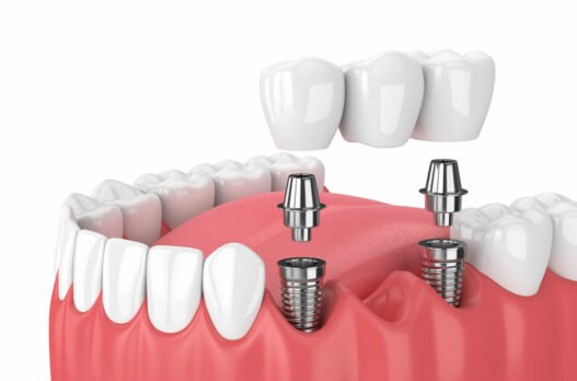 why immediate implants are growing in popularity