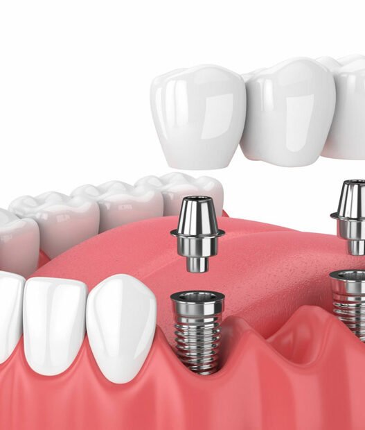 why immediate implants are growing in popularity
