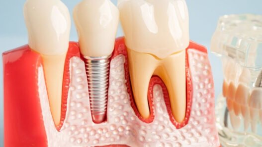 dentures vs dental implants which option is right for you