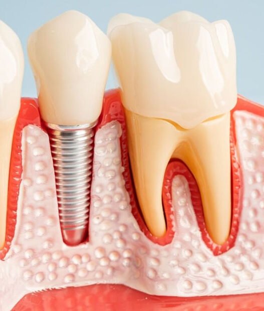 dentures vs dental implants which option is right for you