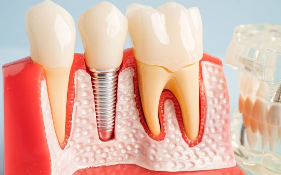 dentures vs dental implants which option is right for you