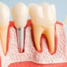dentures vs dental implants which option is right for you