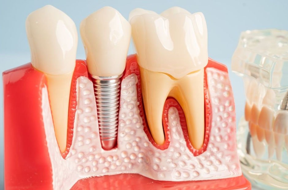 dentures vs dental implants which option is right for you