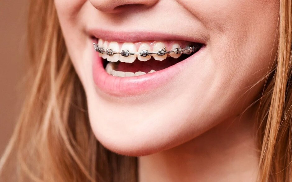 how orthodontic services influence speech and jaw development