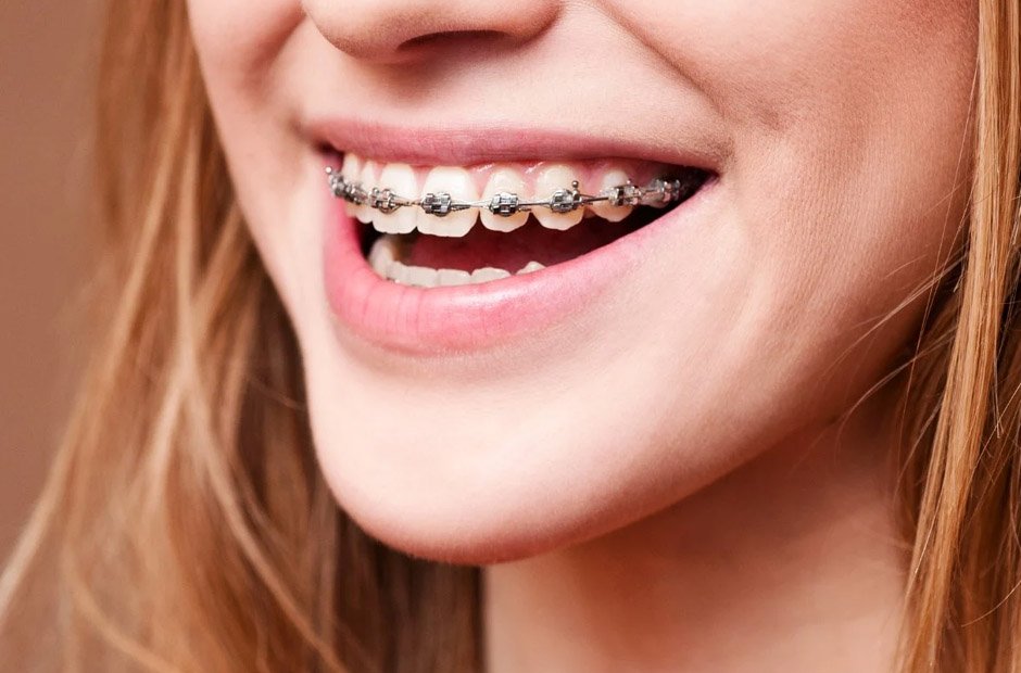 how orthodontic services influence speech and jaw development