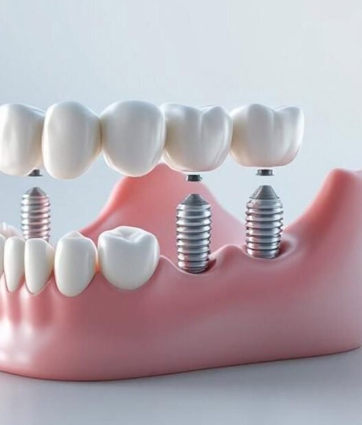 4 restorative dentistry options to replace missing teeth