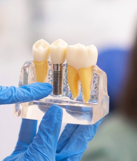 5 benefits of dental implants in restorative dentistry