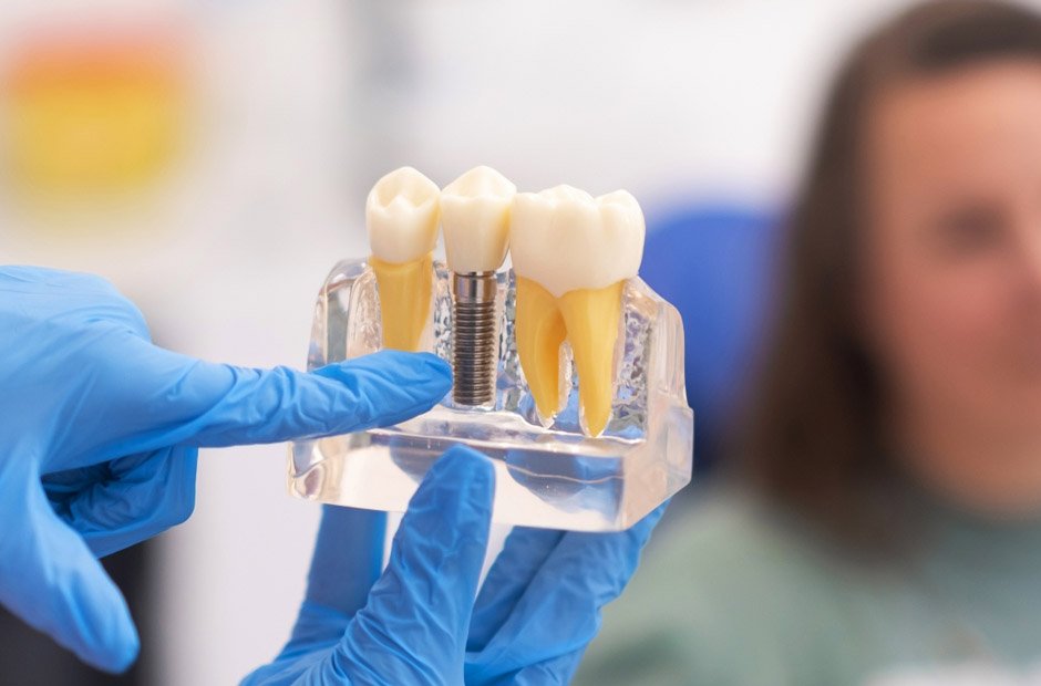 5 benefits of dental implants in restorative dentistry