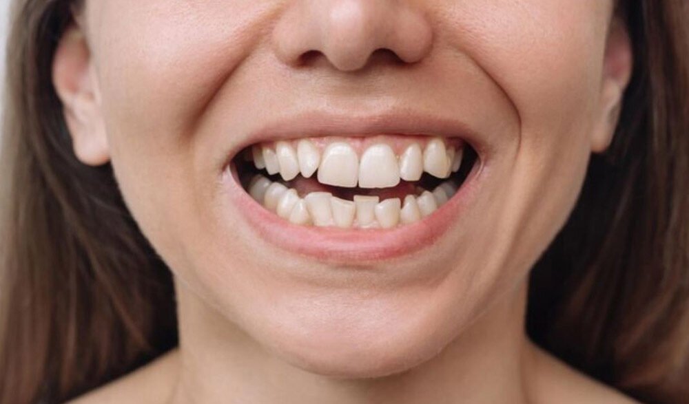 6 common causes of uneven smiles and how dentists correct them
