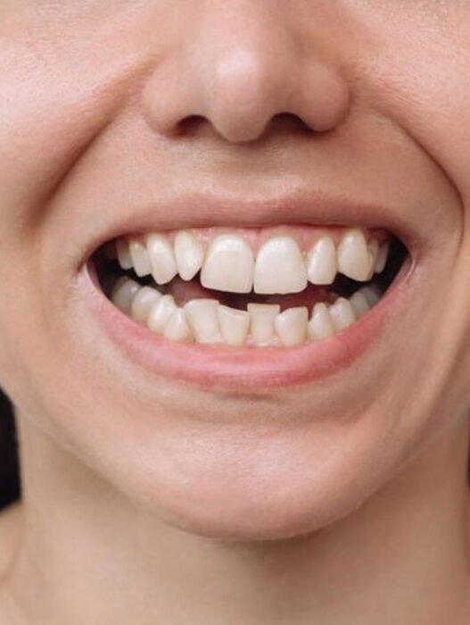 6 common causes of uneven smiles and how dentists correct them