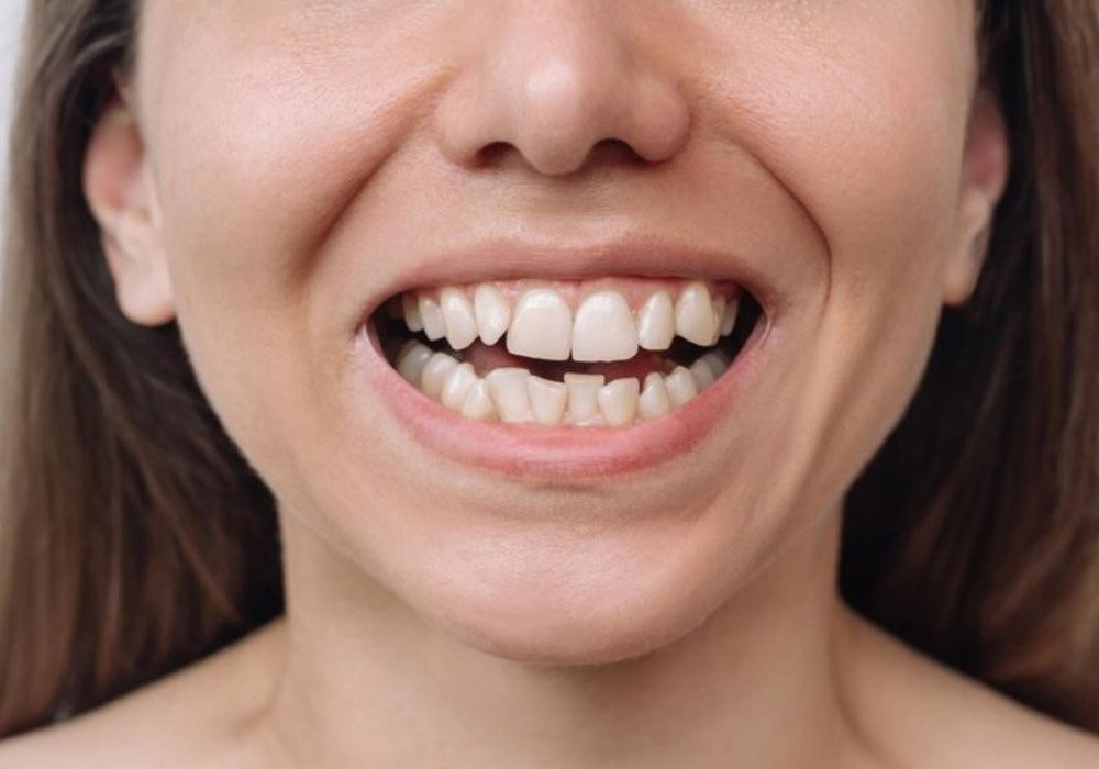 6 common causes of uneven smiles and how dentists correct them